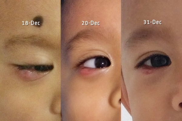 perkembangan kondisi mata setelah insisi bintitan